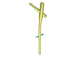 Long- Proximal Femoral Rotational Stability Nail (PFRN) , 130° Long- Proximal Femoral Rotational Stability Nail (PFRN) , 130°