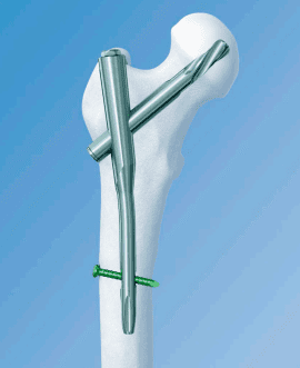 Long- Proximal Femoral Rotational Stability Nail (PFRN) , 130° Long- Proximal Femoral Rotational Stability Nail (PFRN) , 130°